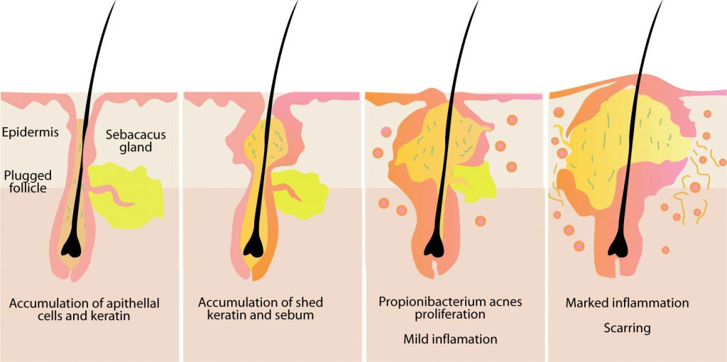 laser-hair-removal